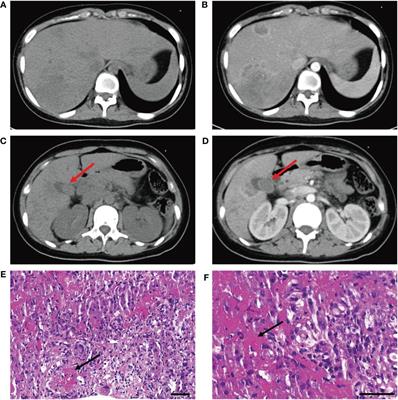 Antiphospholipid antibody-related hepatic vasculitis in a juvenile after non-severe COVID-19: a case report and literature review